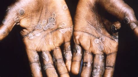 First monkeypox case reported in India: Symptoms, treatment and ...