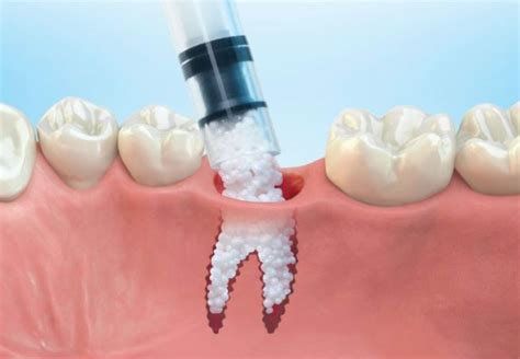 Bone Grafting for Dental Implants - Periodontist in Birmingham, AL ...