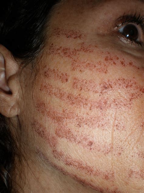 Laser Burn Marks Removal at Richard Buffum blog