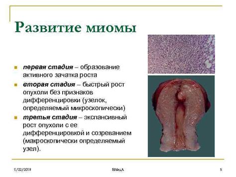 Миома матки Доцент