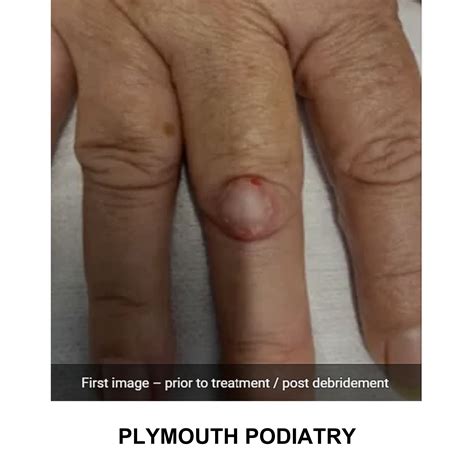 Verrutop Case Studies: Real Results in Verruca Treatment