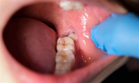 how to get food out wisdom teeth holes