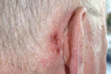 basal cell carcinoma high resolution pictures  text