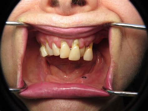 Pterygoid Implants To Avoid Zygomatic Implants And Sinus Lifting