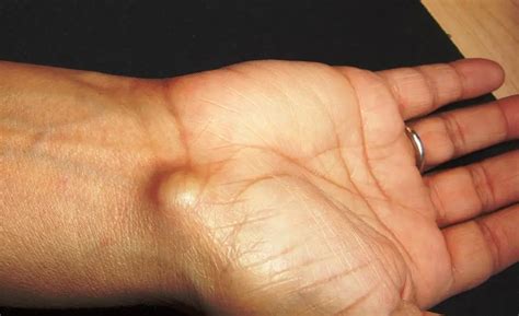 goodbye  ganglion cysts  effective treatments