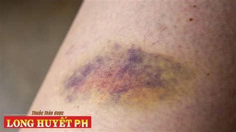 cach lam tan vet bam tim nhanh nhat tai nha long huyet ph tan