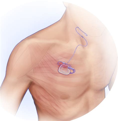 Inspire (for Obstructive Sleep Apnea) | Deborah Heart & Lung Center