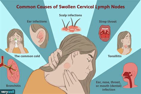 Swollen Lymph Node Symptoms and Causes