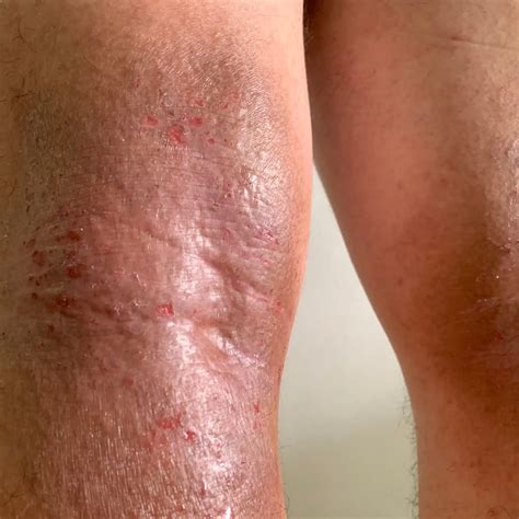 Eczema On Arms And Back