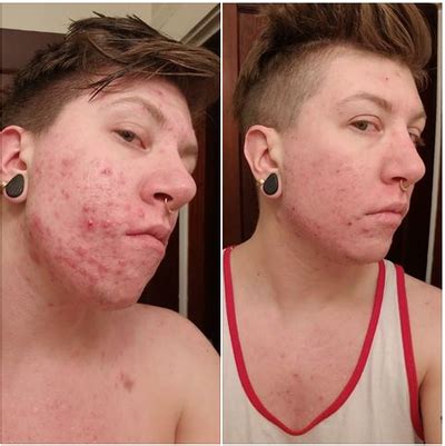 Accutane Before And After Chest