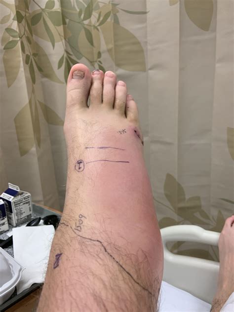 southern pacific rattlesnake bite