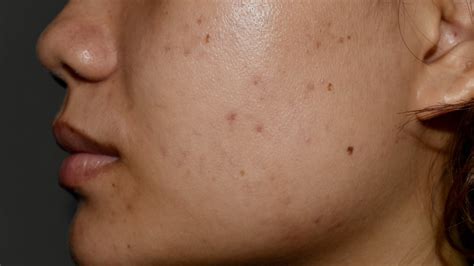 types  hyperpigmentation