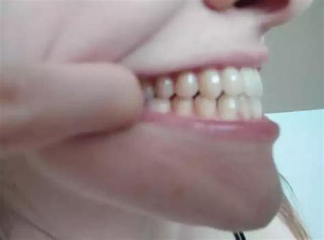 What options do I have in correcting underbite? : r/jawsurgery