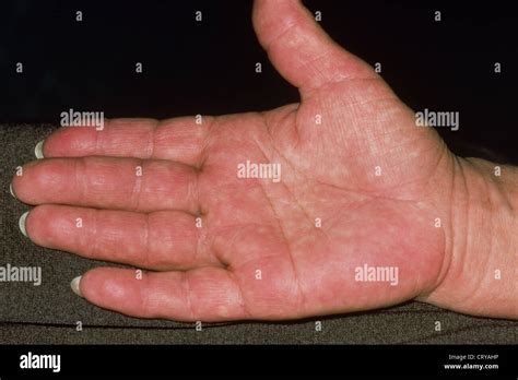 ERYTHEMA Stock Photo - Alamy