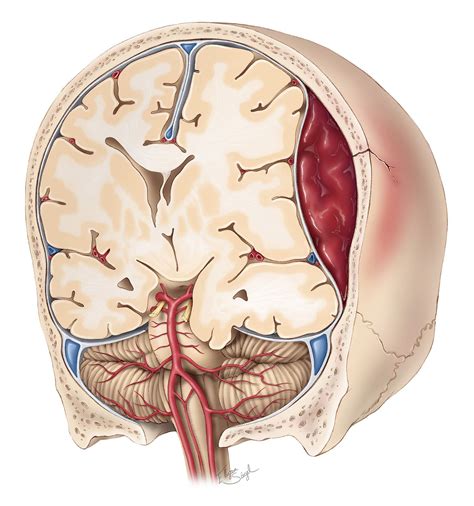 Epidural Hematoma | The Neurosurgical Atlas