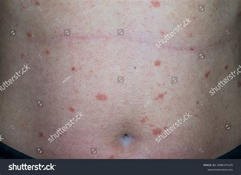 Virus Abdomen Infection Pityriasis Rosea Gibert Stock Photo (Edit Now ...