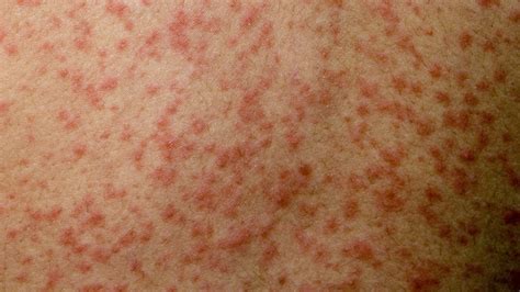 measles outbreak hits  pupils  devon school bbc news