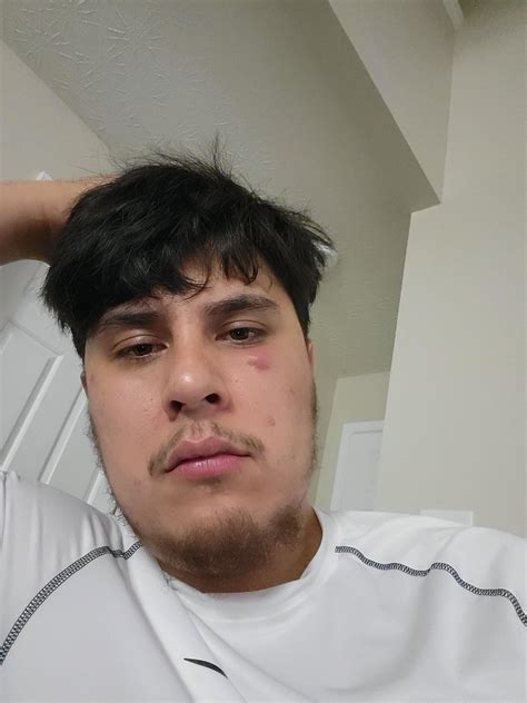 Cyst / swollen bump on face : r/acne