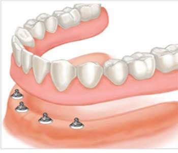 Implant Retained Dentures - The Denture & Implant Clinic