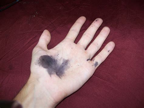 How Does Silver Nitrate Work On Wounds at Anitra Bourne blog