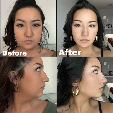Kybella Before and After - Before After Journey