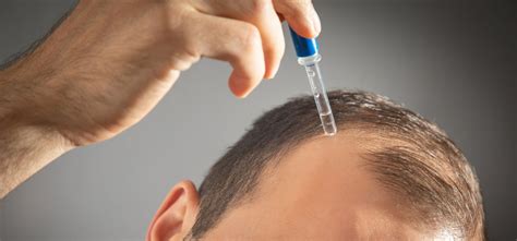 Using Minoxidil and Derma Roller Together for Enhanced Hair Growth