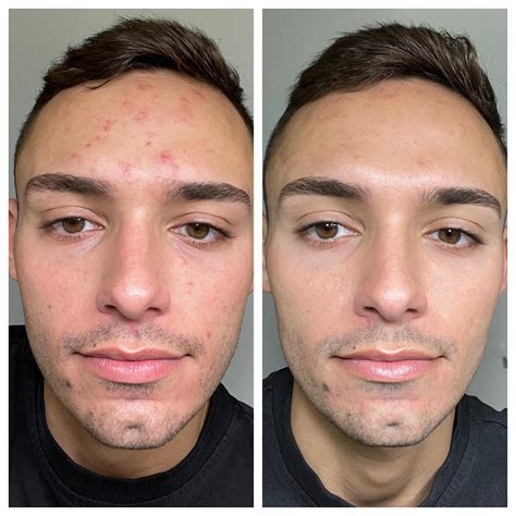 3111 best r/tretinoin images on Pholder | I wanted to give up so badly