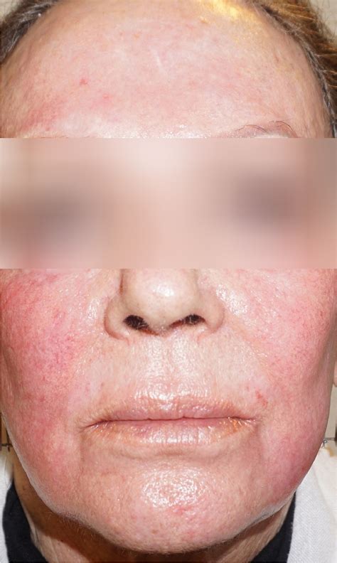 Frontal Fibrosing Alopecia – A New Absolute Contraindication for Deep ...