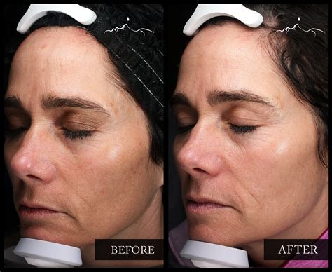 Sophie Rain's BBL:  The Unexpected Side Effects