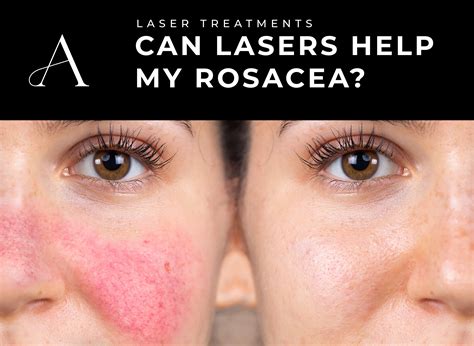 How Effective Is A Rosacea Laser Treatment For Your Skin? - Aesthetics