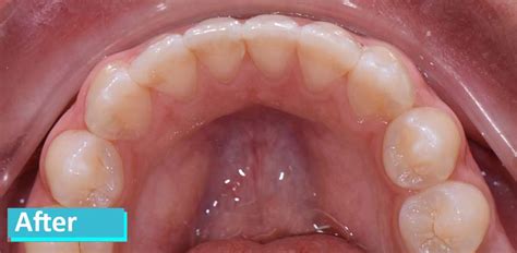 Invisalign After Braces in NYC - Cosmetic, General and Pediatric ...