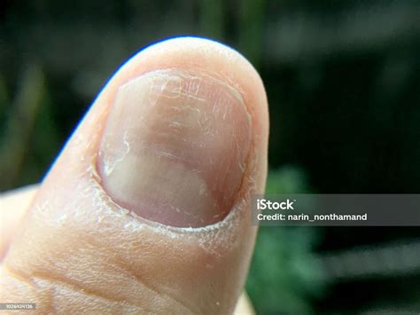 Dedos Descascando Perto Das Unhas - Foto de Grande Perto Do Fungo Infecção Na Mão De Unhas Dedo Com ...