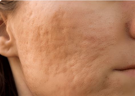 hypertrophic scar      treatment options