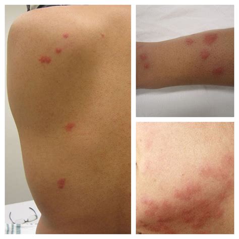 How To Tell Bed Bug Bites From Flea Bites | Sterifab | Bed Bug Blog
