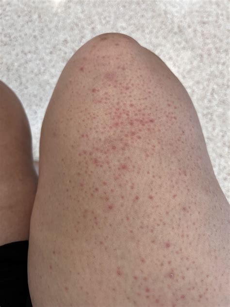 razor bumps on legs