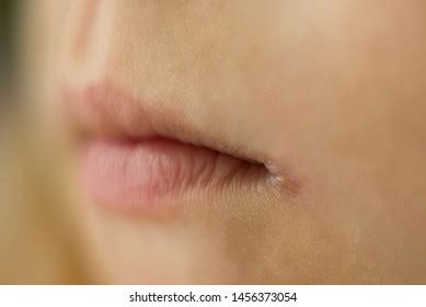 18 Cheilosis Images, Stock Photos & Vectors | Shutterstock