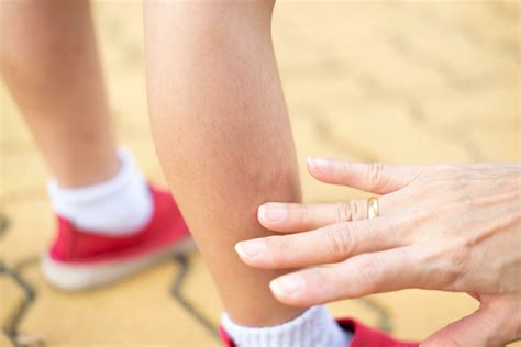 A mother's hand applies medicine to relieve itching from a mosquito