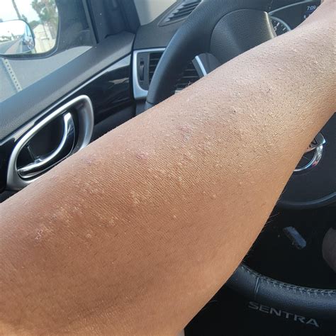 Forearm Rash ? : r/SkincareAddicts