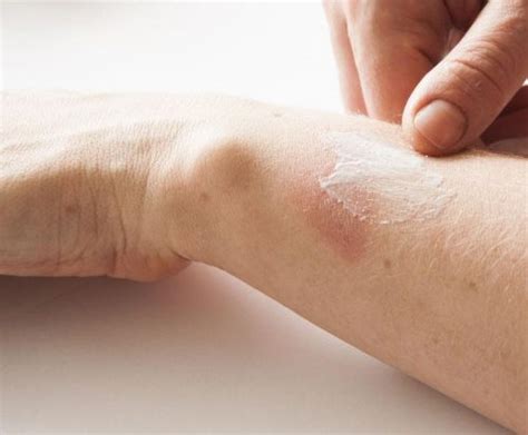 treat  care  minor burns medical monks