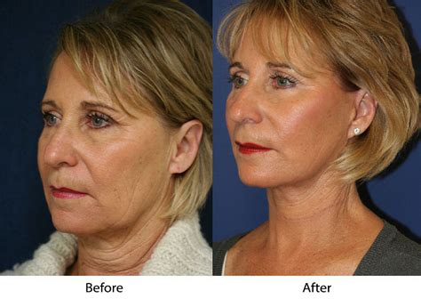 facelift  fillers  facial rejuvenation  los altos ca