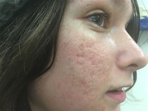 CO2 laser in treating acne scars – ultrapulse & Subcision of Acne Scars