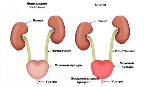Зуд и жжение при мочеиспускании у женщин: причины, профилактика