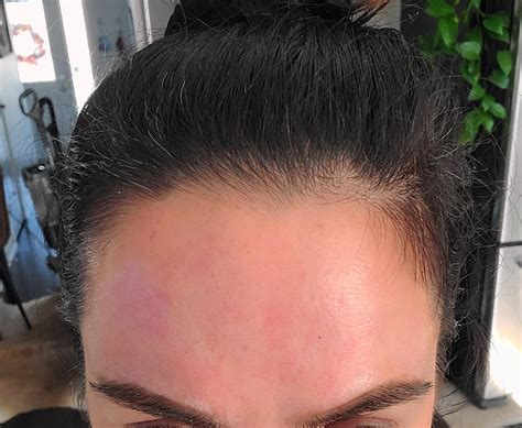 [Skin concern] Red splotches all over my face after Vitamin C and