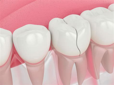 Broken Molar