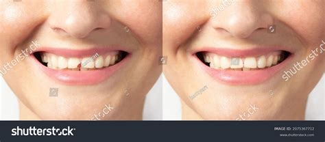 4 Secret Remedies To Mend Your Broken Smile