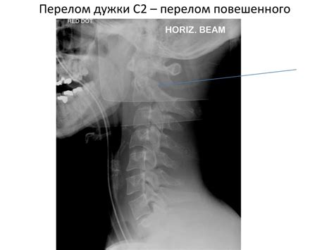 Повреждения позвоночника - презентация онлайн