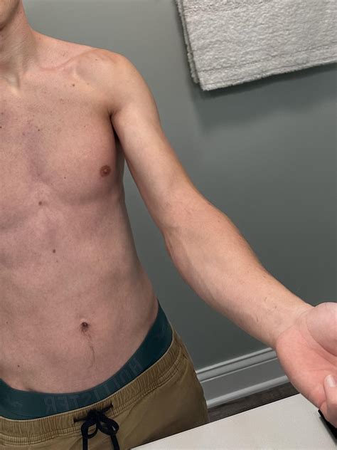 HIV Rash? : r/HIV