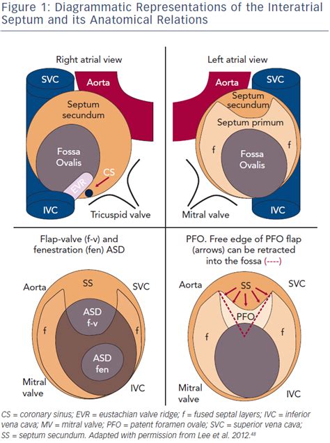 atrial septal defect pathophysiology ppt