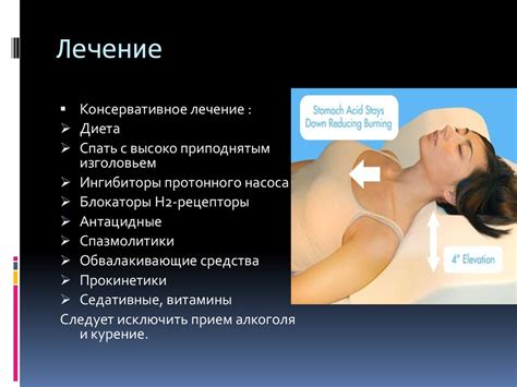 Рефлюкс-эзофагит - презентация онлайн