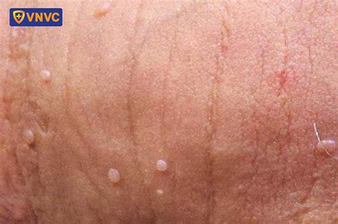 sui mao ga  duong vat  nguy hiem khong cach chua benh